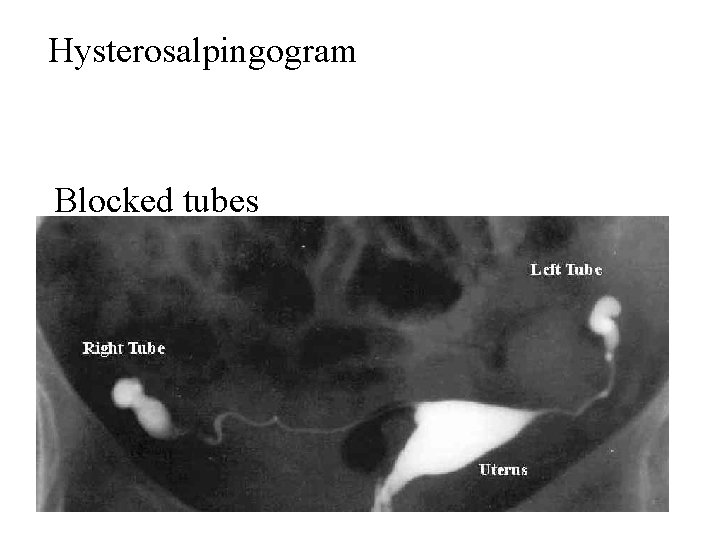 Hysterosalpingogram Blocked tubes 