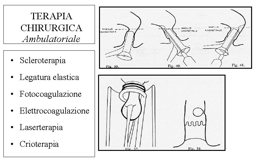 TERAPIA CHIRURGICA Ambulatoriale • Scleroterapia • Legatura elastica • Fotocoagulazione • Elettrocoagulazione • Laserterapia