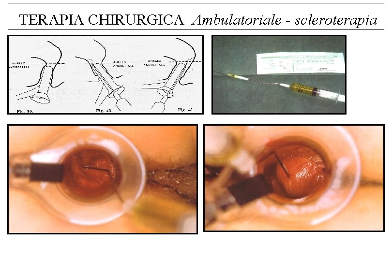 TERAPIA CHIRURGICA Ambulatoriale - scleroterapia 