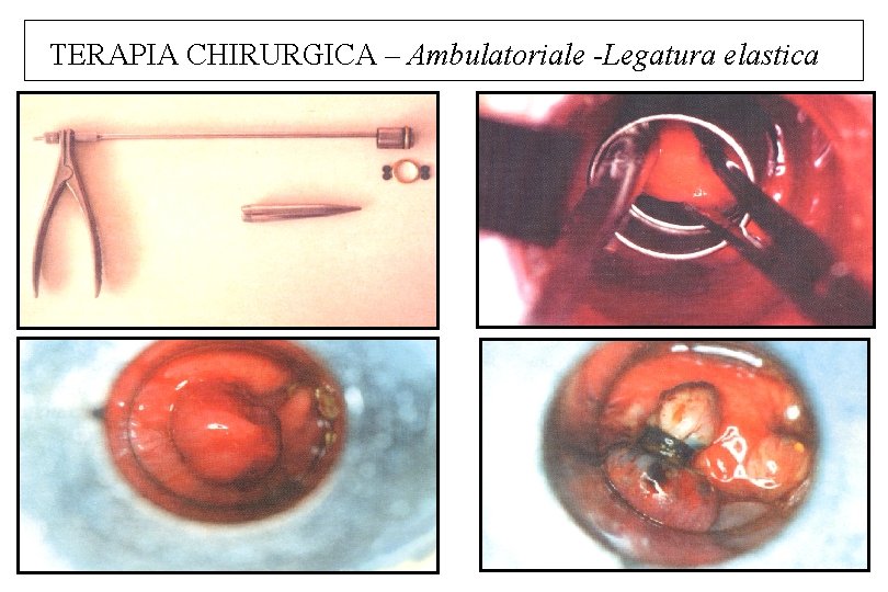 TERAPIA CHIRURGICA – Ambulatoriale -Legatura elastica 