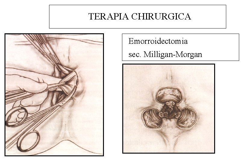 TERAPIA CHIRURGICA Emorroidectomia sec. Milligan-Morgan 