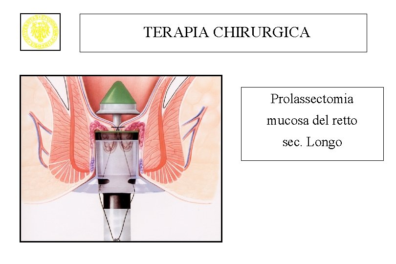 TERAPIA CHIRURGICA Prolassectomia mucosa del retto sec. Longo 