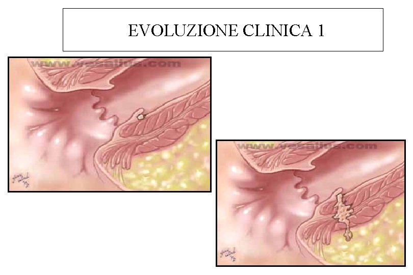 EVOLUZIONE CLINICA 1 