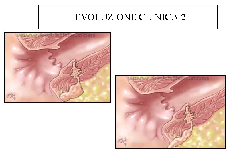 EVOLUZIONE CLINICA 2 