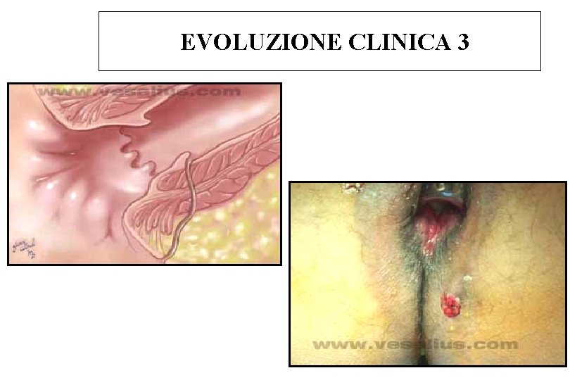 EVOLUZIONE CLINICA 3 