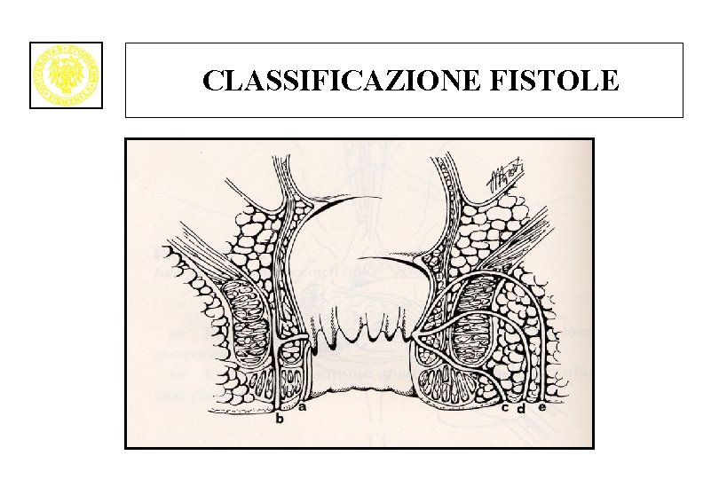 CLASSIFICAZIONE FISTOLE 
