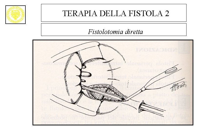 TERAPIA DELLA FISTOLA 2 Fistolotomia diretta 