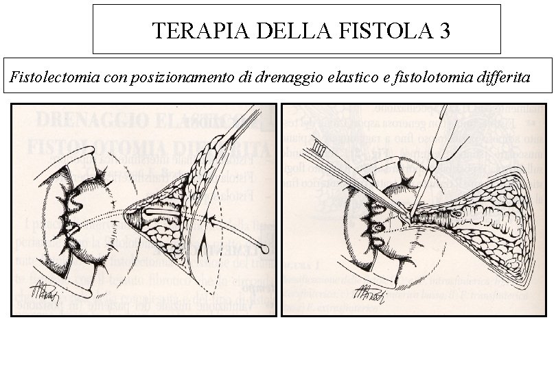 TERAPIA DELLA FISTOLA 3 Fistolectomia con posizionamento di drenaggio elastico e fistolotomia differita 