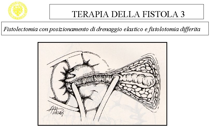 TERAPIA DELLA FISTOLA 3 Fistolectomia con posizionamento di drenaggio elastico e fistolotomia differita 