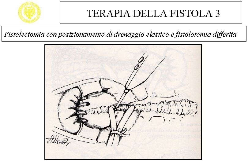 TERAPIA DELLA FISTOLA 3 Fistolectomia con posizionamento di drenaggio elastico e fistolotomia differita 