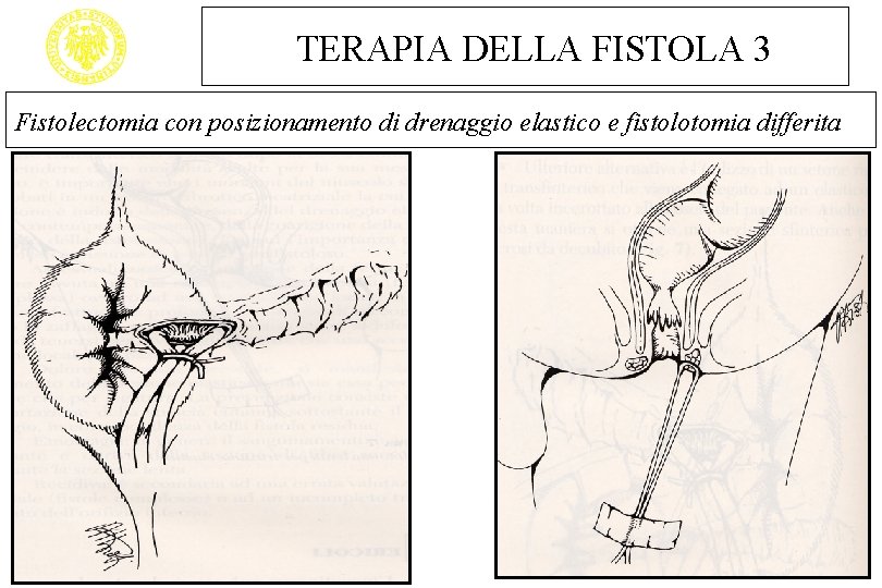 TERAPIA DELLA FISTOLA 3 Fistolectomia con posizionamento di drenaggio elastico e fistolotomia differita 