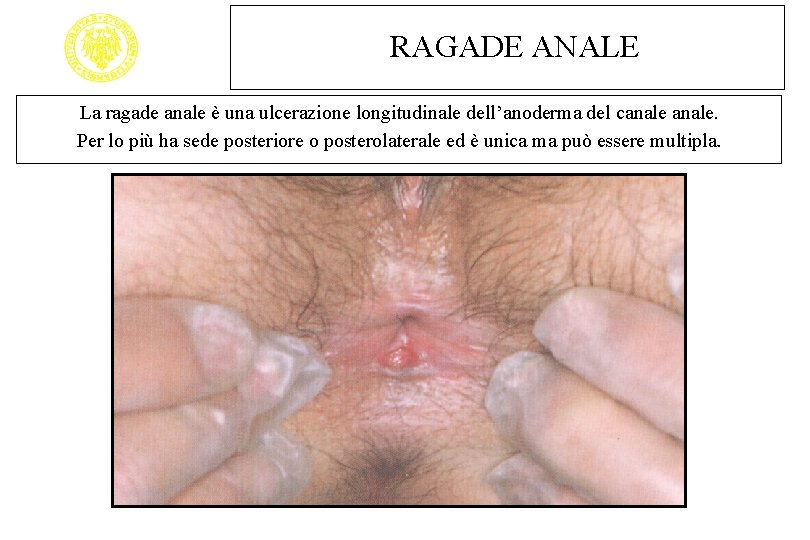 RAGADE ANALE La ragade anale è una ulcerazione longitudinale dell’anoderma del canale. Per lo