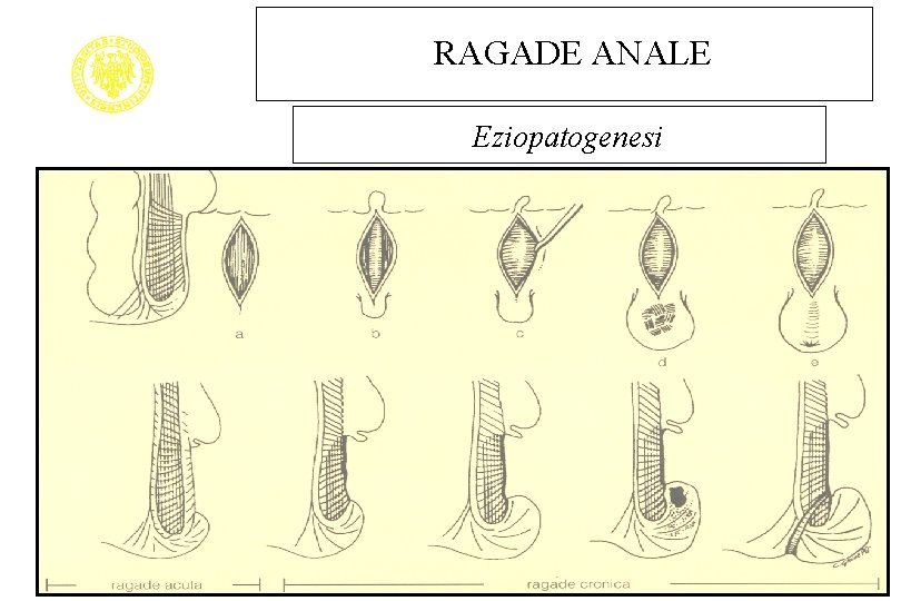 RAGADE ANALE Eziopatogenesi 