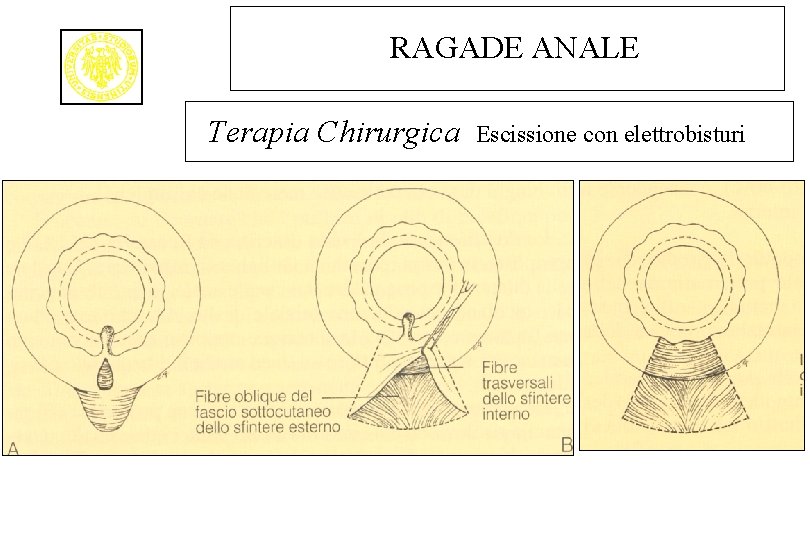 RAGADE ANALE Terapia Chirurgica Escissione con elettrobisturi 