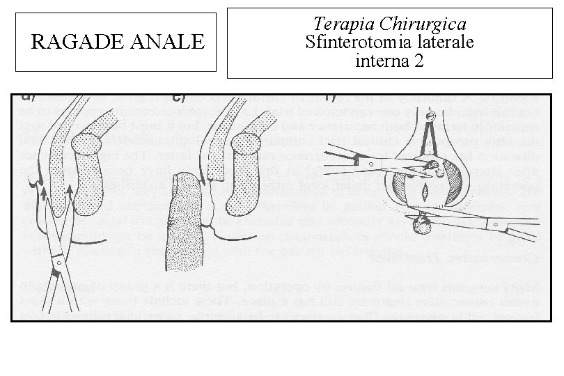 RAGADE ANALE Terapia Chirurgica Sfinterotomia laterale interna 2 