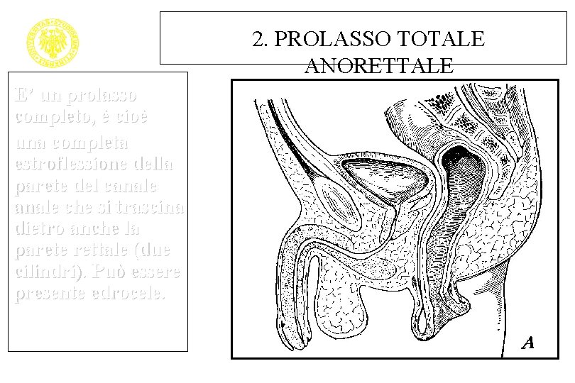 2. PROLASSO TOTALE ANORETTALE E’ un prolasso completo, è cioè una completa estroflessione della