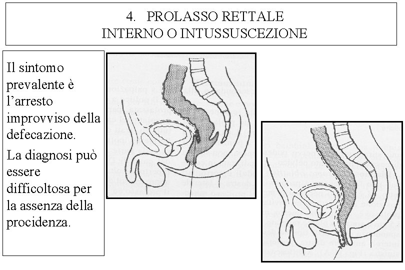 4. PROLASSO RETTALE INTERNO O INTUSSUSCEZIONE Il sintomo prevalente è l’arresto improvviso della defecazione.