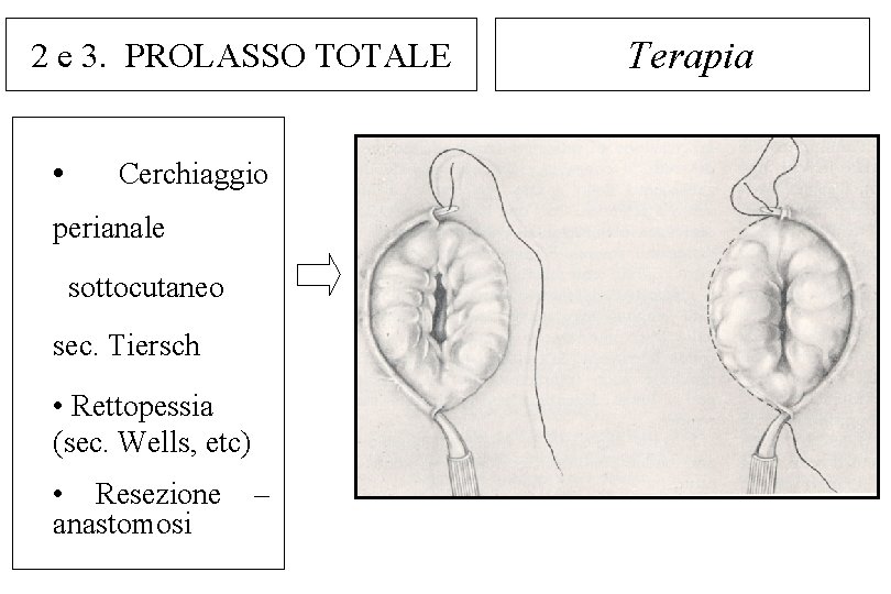 2 e 3. PROLASSO TOTALE • Cerchiaggio perianale sottocutaneo sec. Tiersch • Rettopessia (sec.