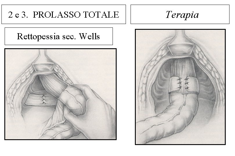 2 e 3. PROLASSO TOTALE Rettopessia sec. Wells Terapia 