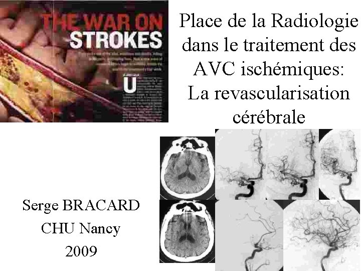 Place de la Radiologie dans le traitement des AVC ischémiques: La revascularisation cérébrale Serge