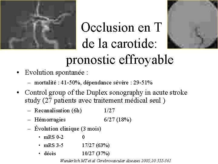  Occlusion en T de la carotide: pronostic effroyable • Evolution spontanée : –