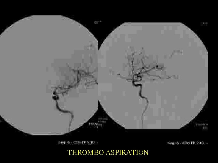 THROMBO ASPIRATION 