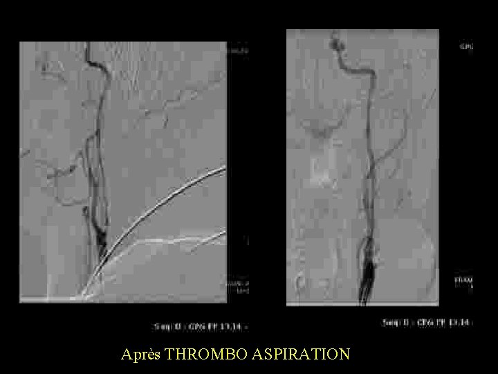 Après THROMBO ASPIRATION 