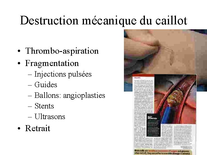 Destruction mécanique du caillot • Thrombo-aspiration • Fragmentation – Injections pulsées – Guides –