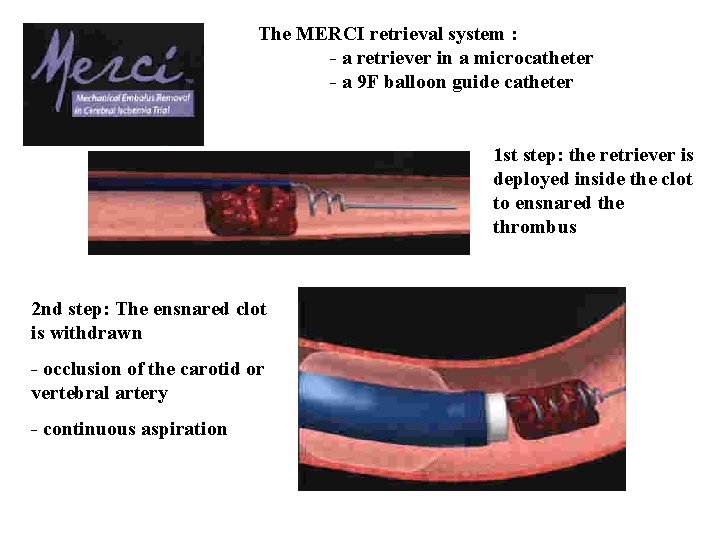 The MERCI retrieval system : - a retriever in a microcatheter - a 9