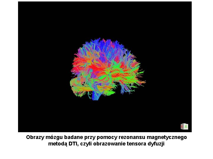 Obrazy mózgu badane przy pomocy rezonansu magnetycznego metodą DTI, czyli obrazowanie tensora dyfuzji 