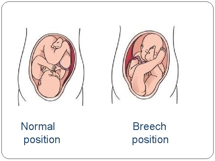 DDH Developmental dysplasia of the hip Saja Aloran