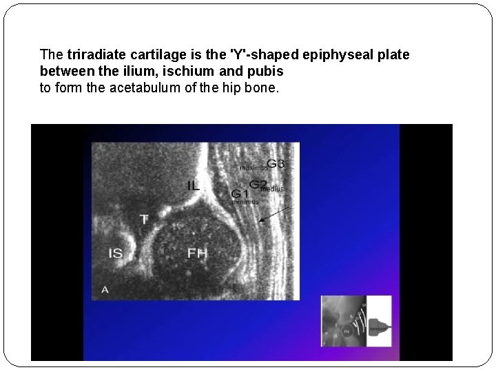 The triradiate cartilage is the 'Y'-shaped epiphyseal plate between the ilium, ischium and pubis