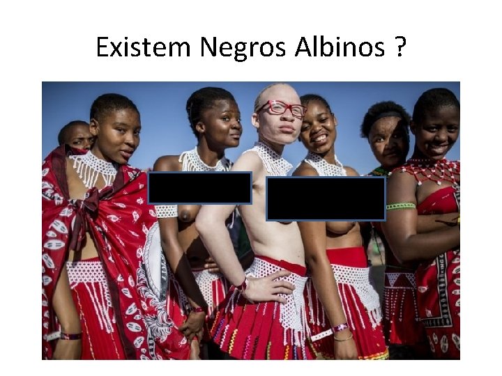 Existem Negros Albinos ? 