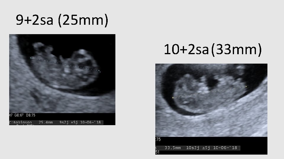 9+2 sa (25 mm) 10+2 sa (33 mm) 