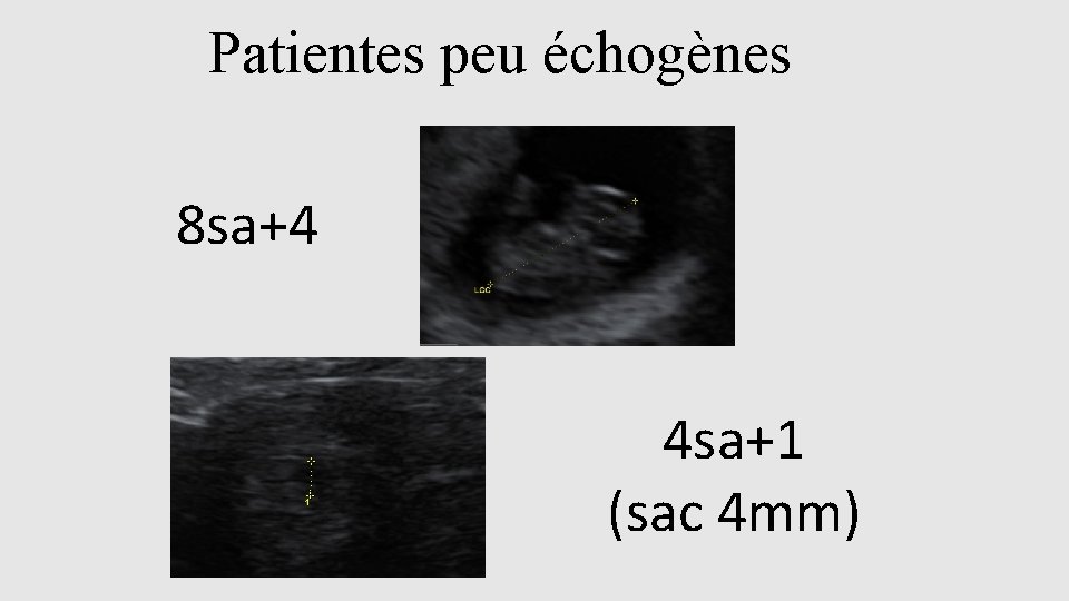 Patientes peu échogènes 8 sa+4 4 sa+1 (sac 4 mm) 