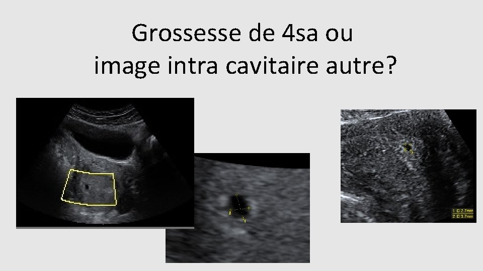 Grossesse de 4 sa ou image intra cavitaire autre? 
