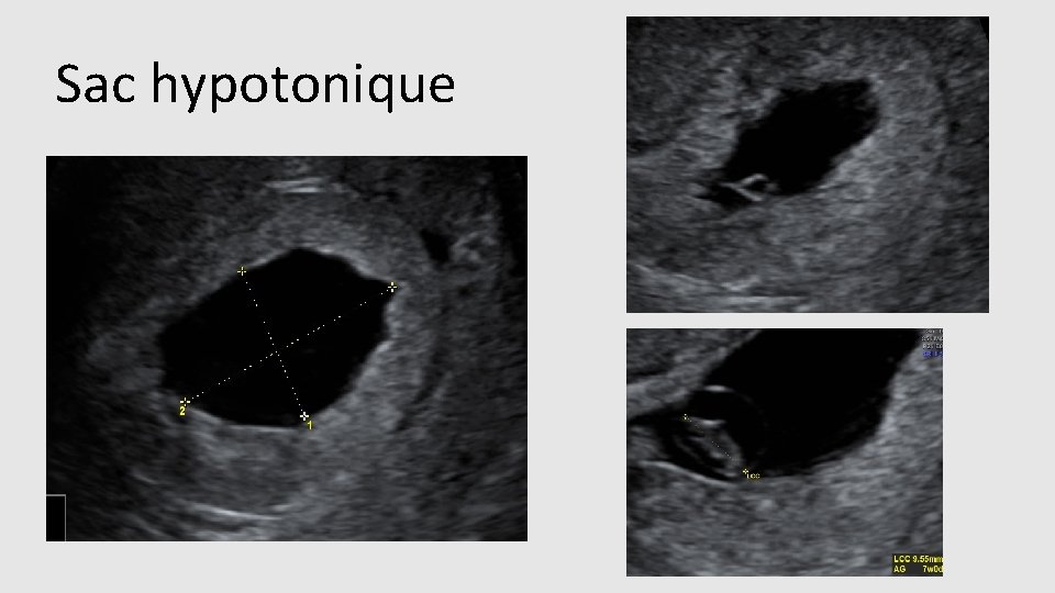 Sac hypotonique 