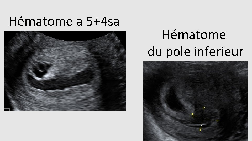 Hématome a 5+4 sa Hématome du pole inferieur 