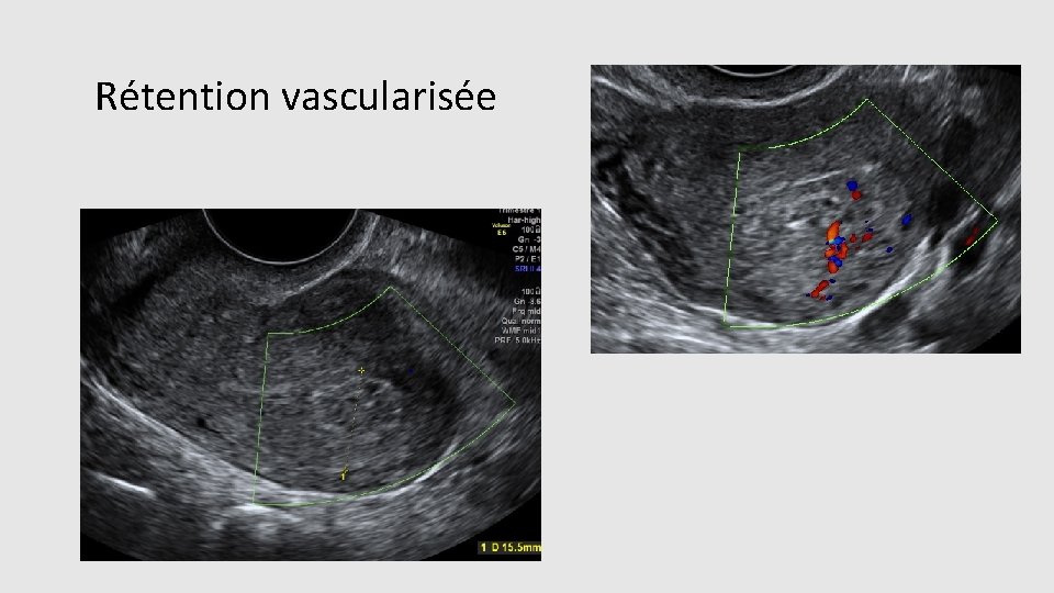 Rétention vascularisée 