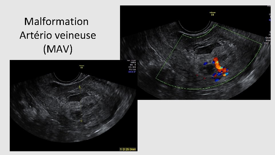 Malformation Artério veineuse (MAV) 