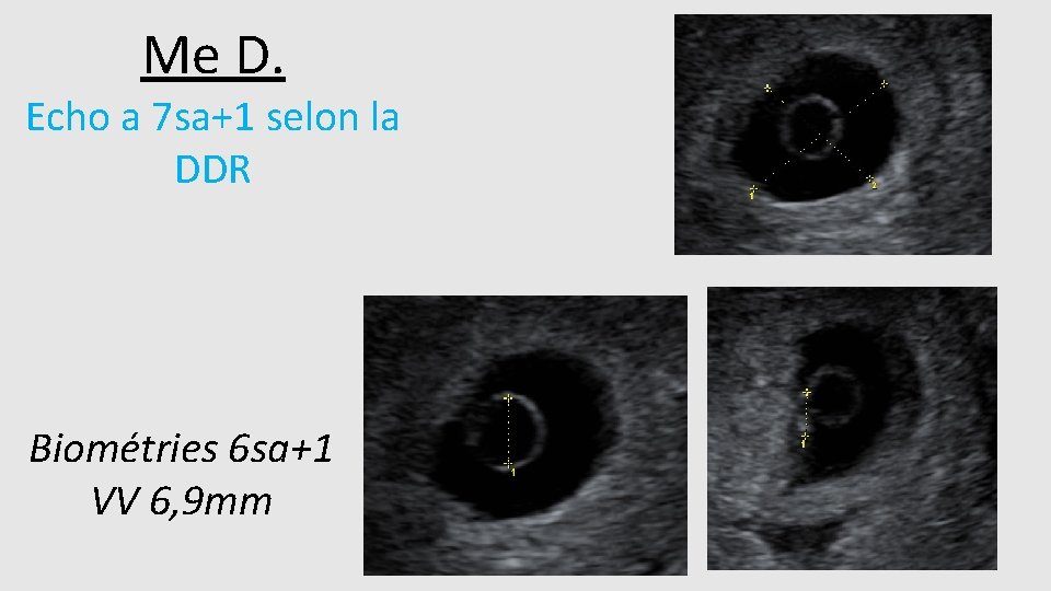 Me D. Echo a 7 sa+1 selon la DDR Biométries 6 sa+1 VV 6,