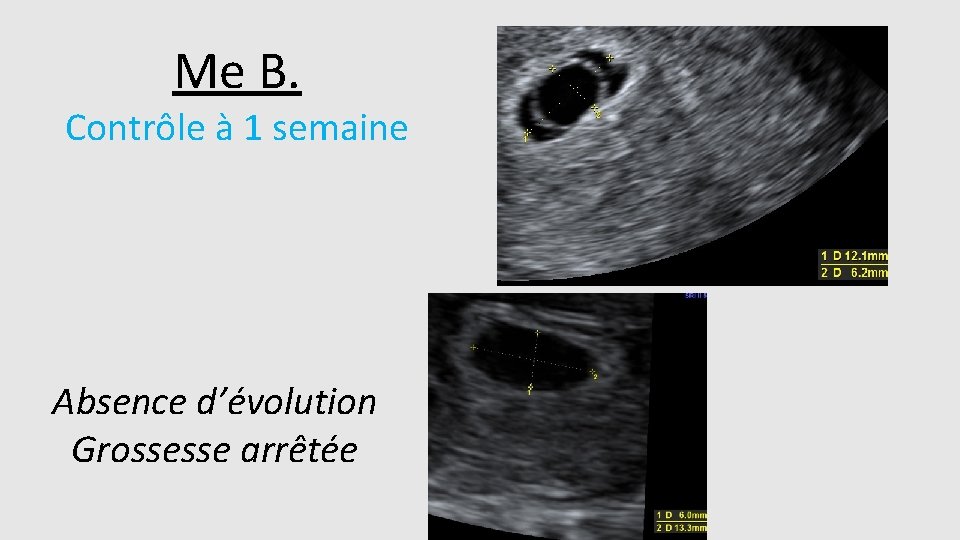 Me B. Contrôle à 1 semaine Absence d’évolution Grossesse arrêtée 