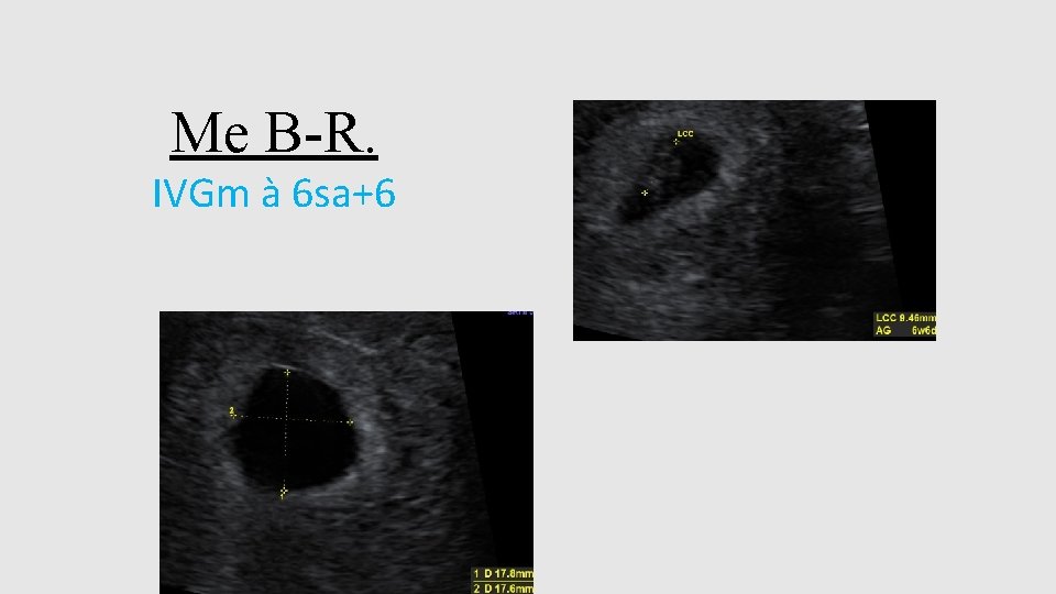 Me B-R. IVGm à 6 sa+6 