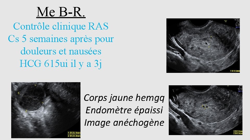 Me B-R. Contrôle clinique RAS Cs 5 semaines après pour douleurs et nausées HCG