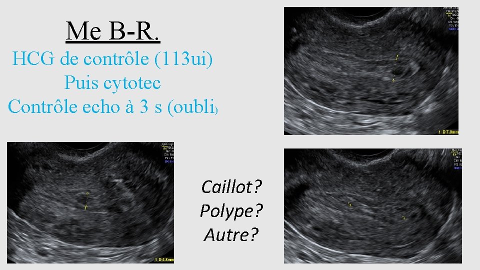 Me B-R. HCG de contrôle (113 ui) Puis cytotec Contrôle echo à 3 s