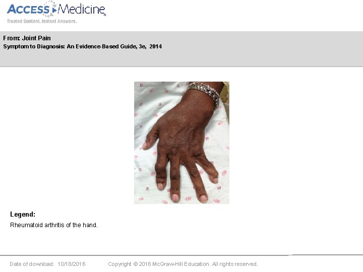 From: Joint Pain Symptom to Diagnosis: An Evidence-Based Guide, 3 e, 2014 Legend: Rheumatoid