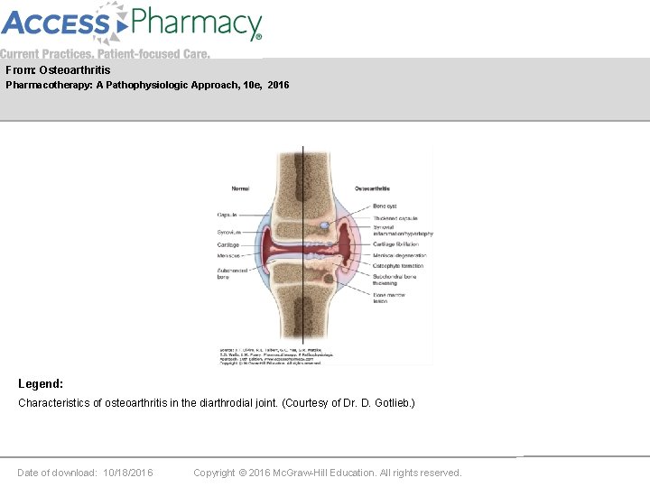 From: Osteoarthritis Pharmacotherapy: A Pathophysiologic Approach, 10 e, 2016 Legend: Characteristics of osteoarthritis in