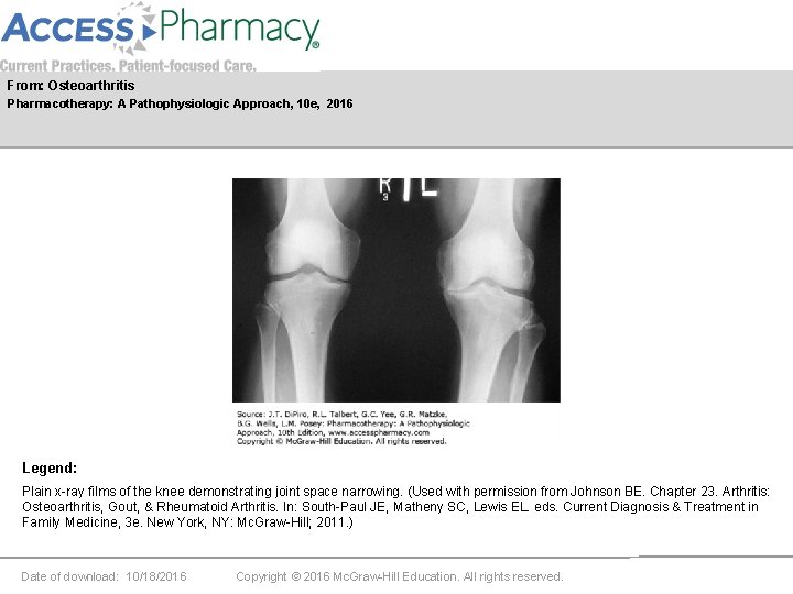 From: Osteoarthritis Pharmacotherapy: A Pathophysiologic Approach, 10 e, 2016 Legend: Plain x-ray films of