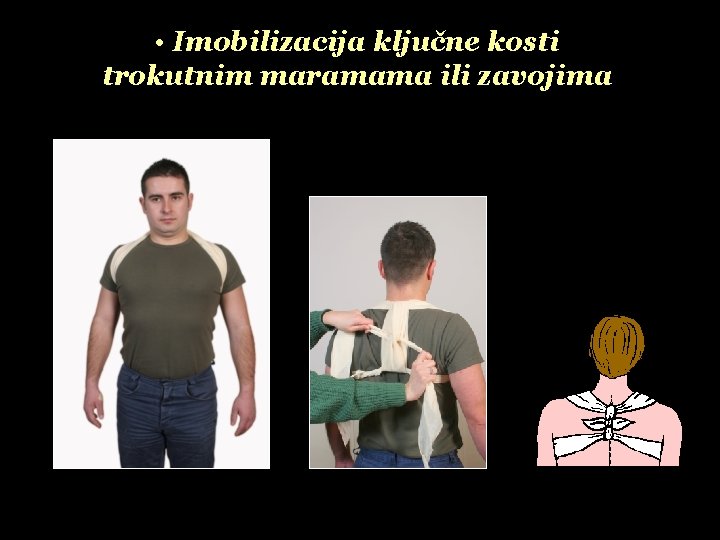  • Imobilizacija ključne kosti trokutnim maramama ili zavojima 