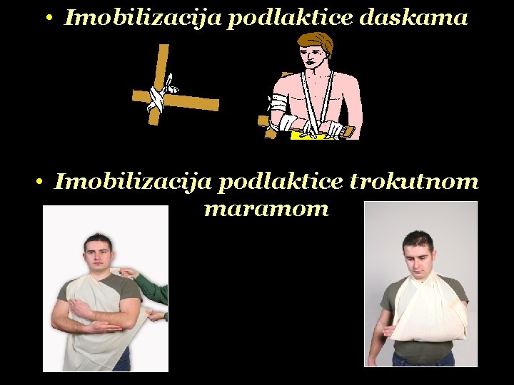  • Imobilizacija podlaktice daskama • Imobilizacija podlaktice trokutnom maramom 